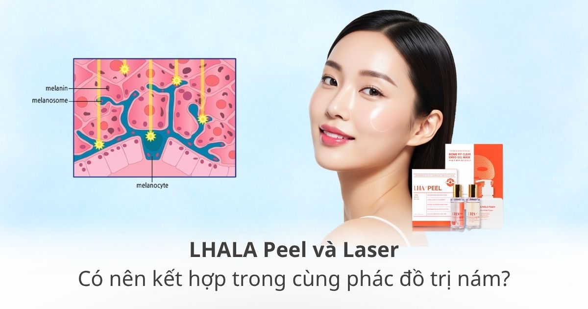 Laser và LHALA peel kết hợp phác đồ trị nám