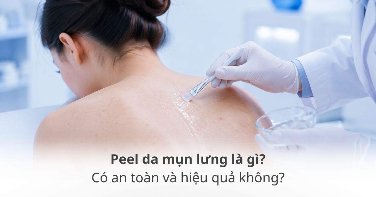 Peel da mụn lưng có an toàn và hiệu quả không