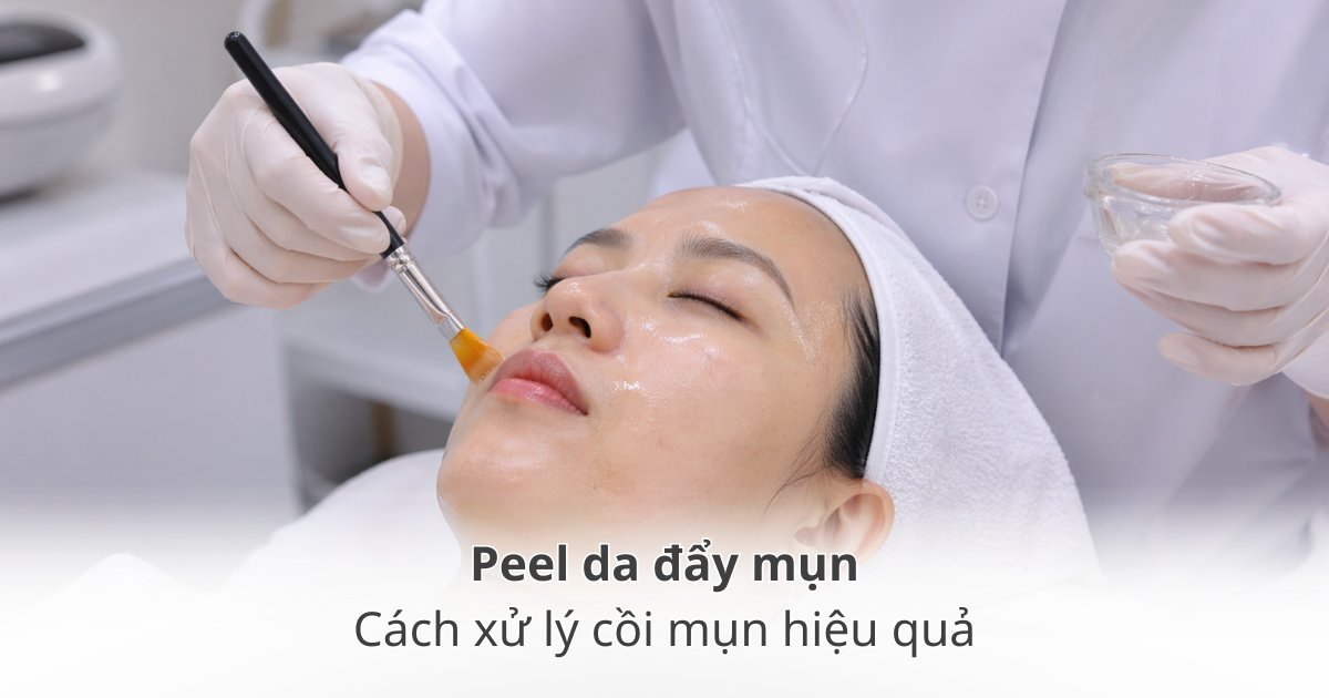 Peel da đẩy mụn và cách xử lý cồi mụn hiệu quả