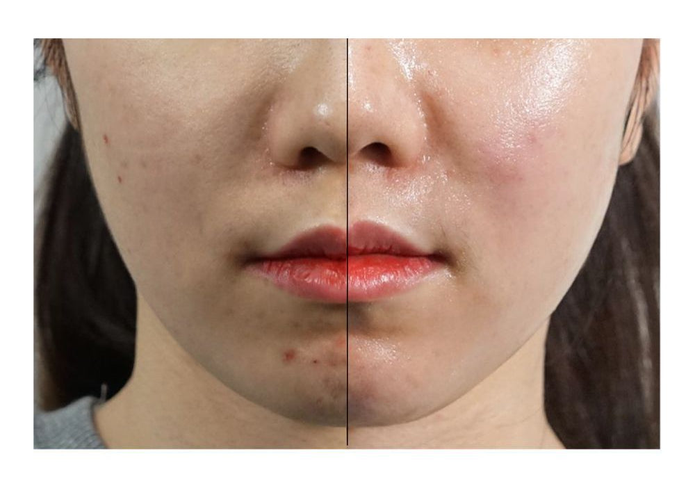 Hình ảnh trước và sau khi dùng peel LHALA